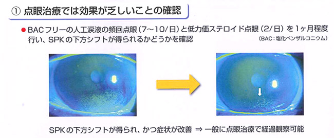 1.点眼治療では効果が乏しいことの確認