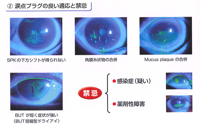 2.涙点プラグの良い適応と禁忌