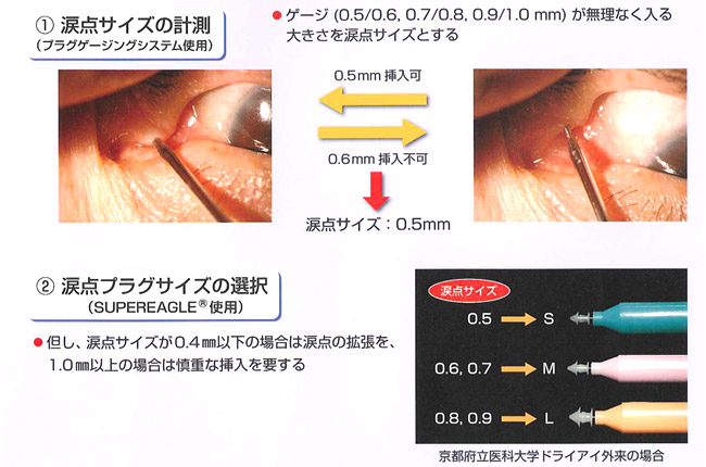 1.涙点サイズの測定　2.涙点プラグサイズの選択