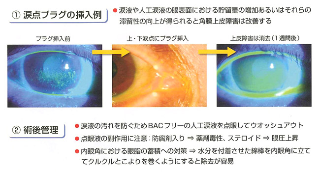 涙点プラグの挿入例